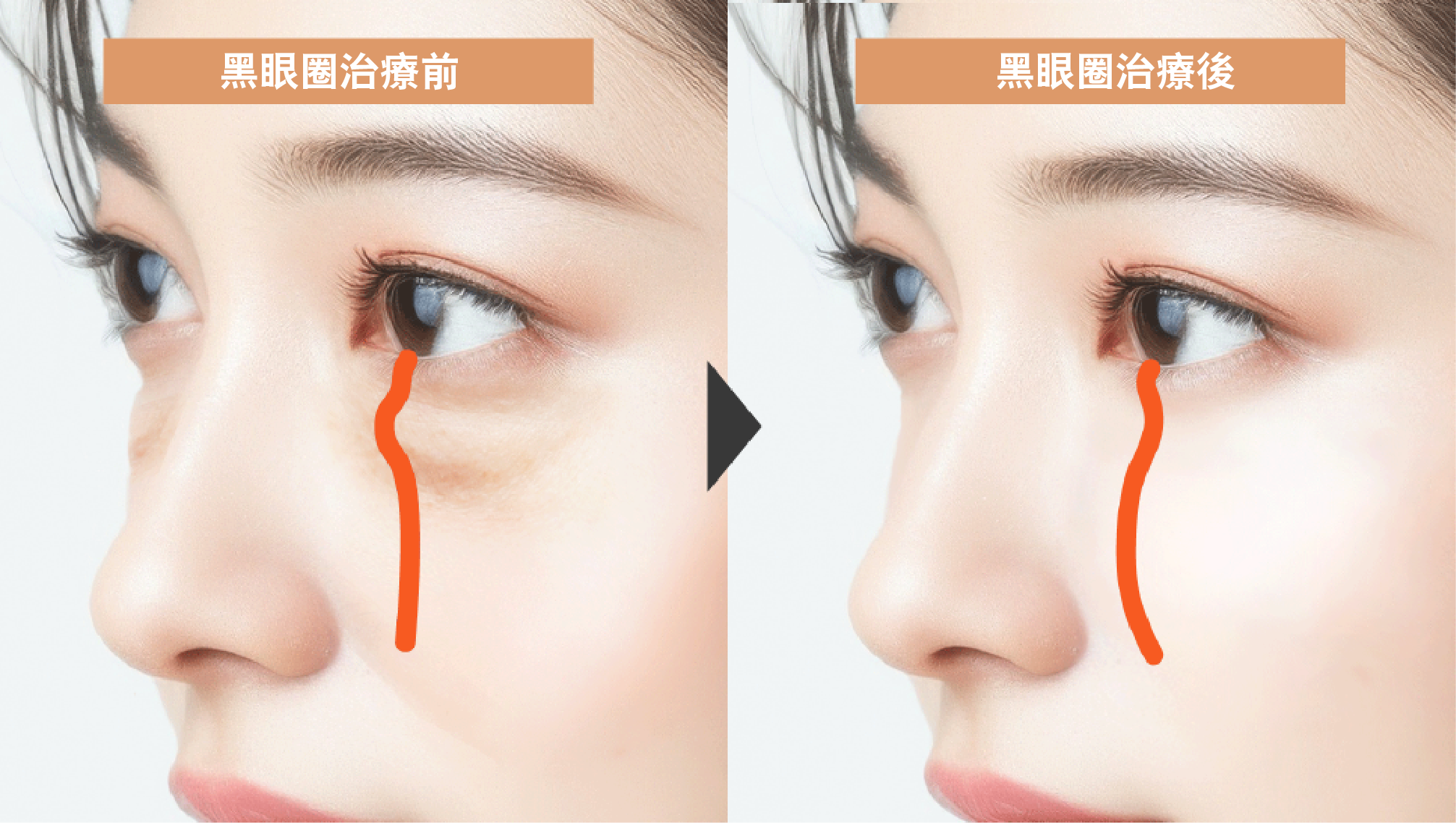 膨らみ溝の成り立ち