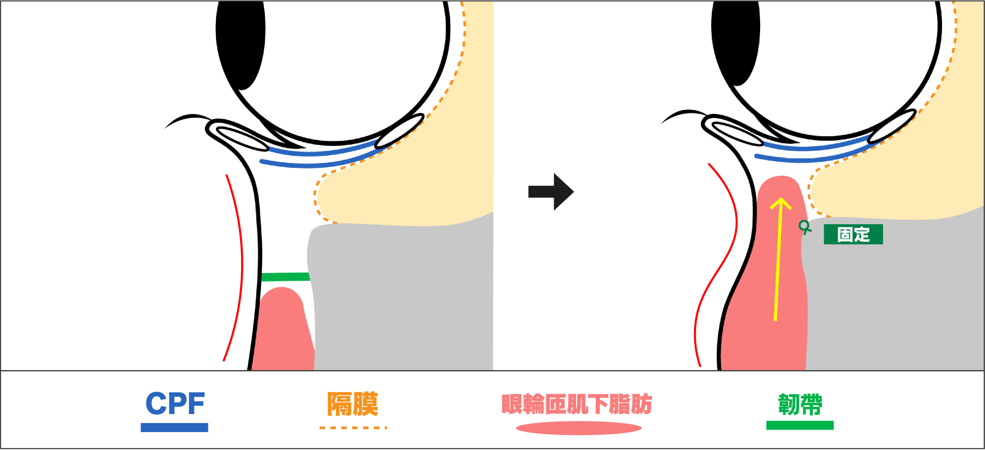 裏ハムラ法とは