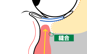 上顎骨と眼輪筋・眼輪筋下脂肪体を剥離し、さらに靭帯を剥離して、後々眼窩脂肪ズラすためのポケットを作成