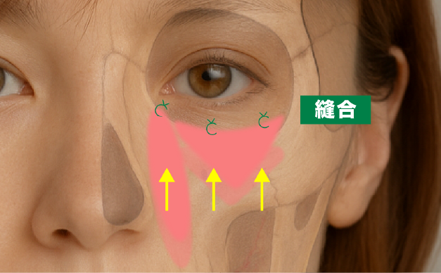 隔膜を破り、眼窩脂肪弁、隔膜・CPF前葉複合弁を作成