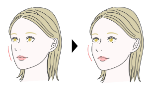 眼窩脂肪弁を靭帯の下にズラします。稀にポケットに収まらない場合は多少脂肪を減量