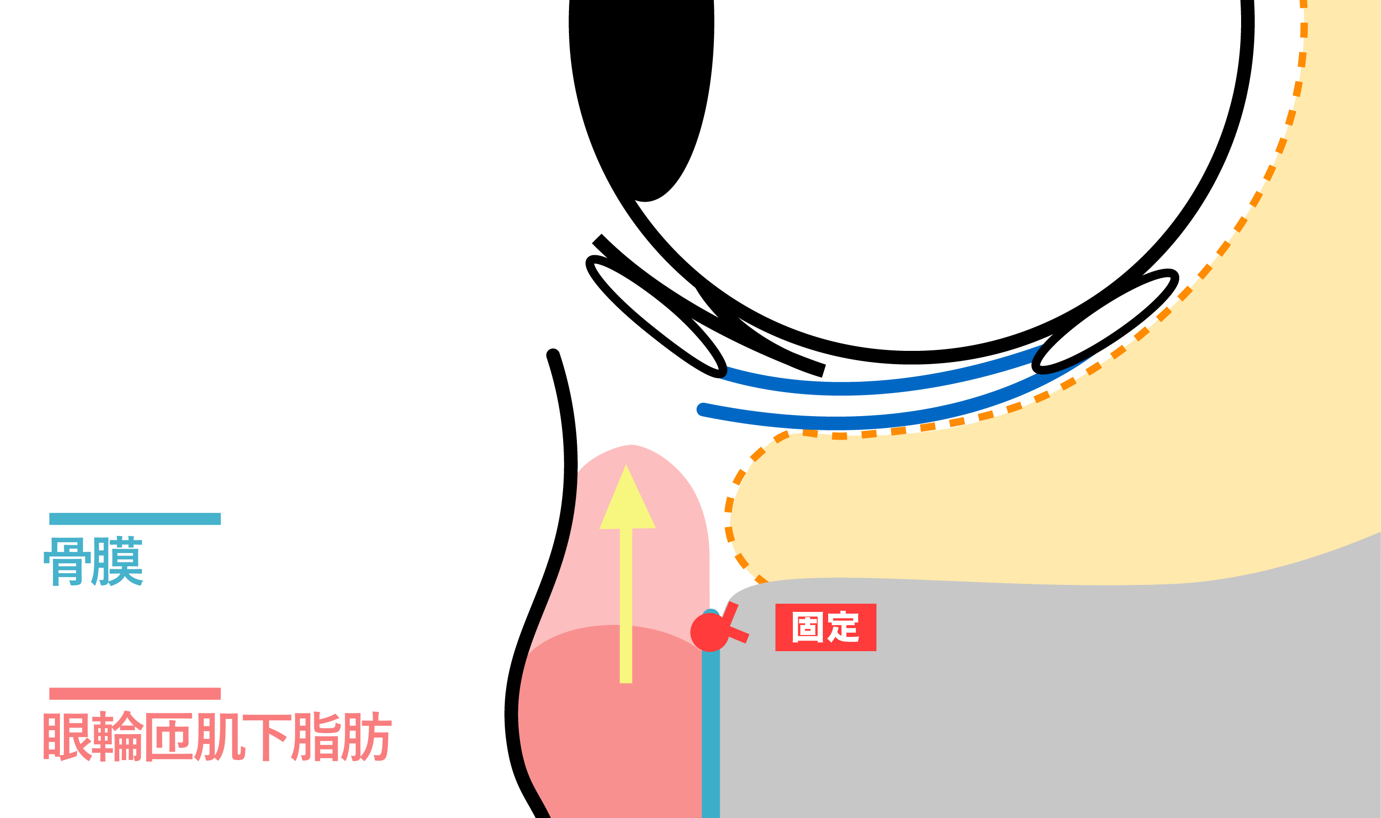 骨膜上拉提（evo拉提）