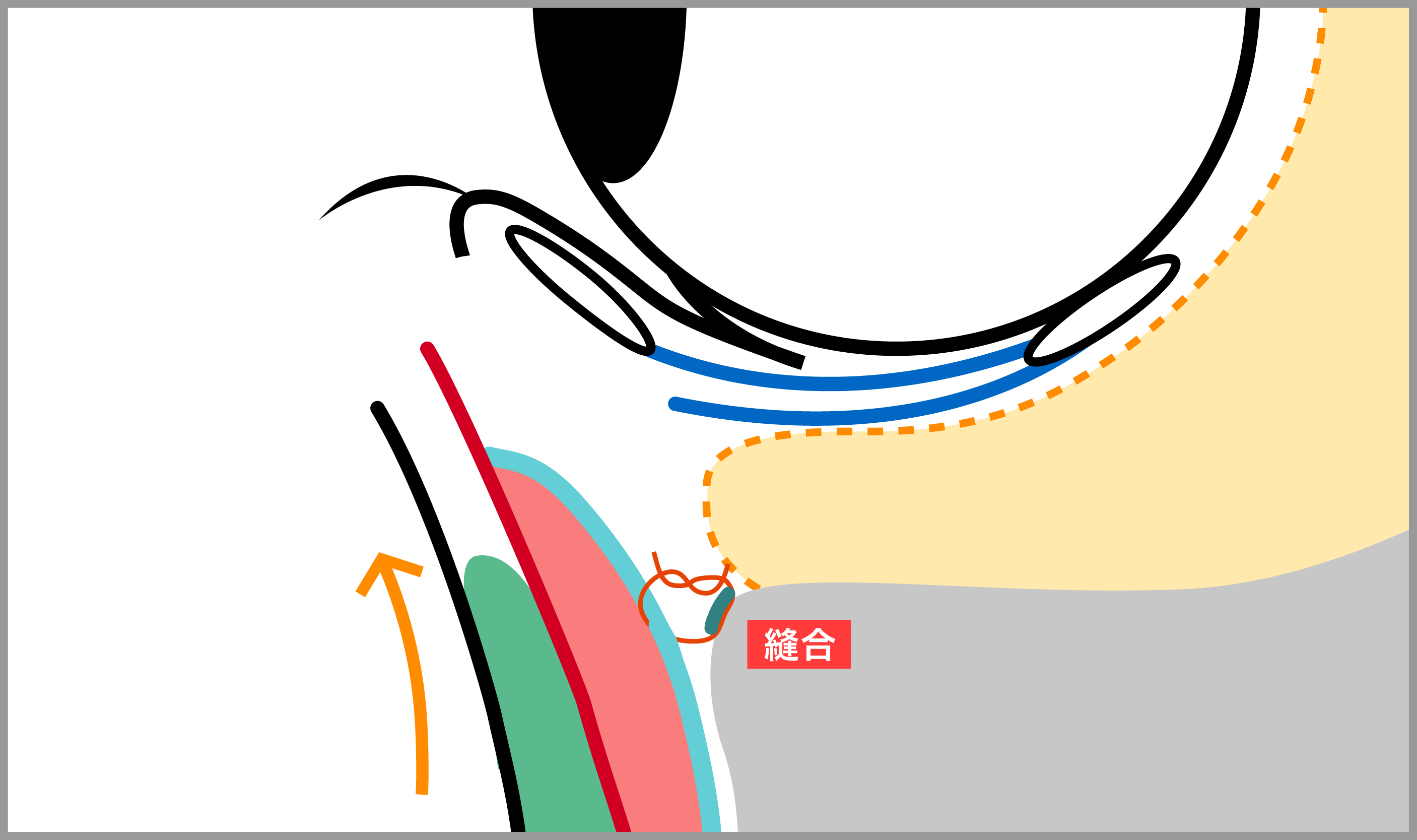 凹まず自然な仕上がりに