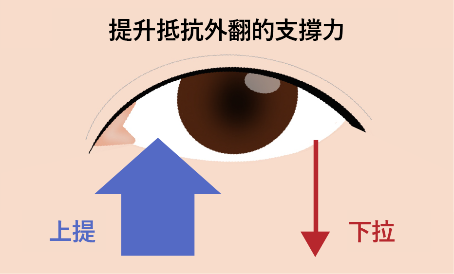 以提升為基礎的中臉組織可抵消多餘皮膚切除所產生的下拉向量具有降低外翻風險的優勢