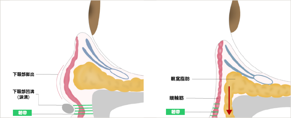 What is the Transconjunctival Orbital Fat Repositioning?
