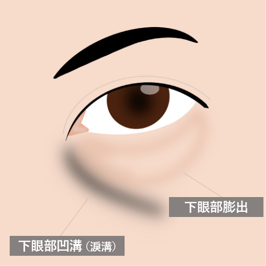 Candidates for the  Transconjunctival Orbital Fat Repositioning