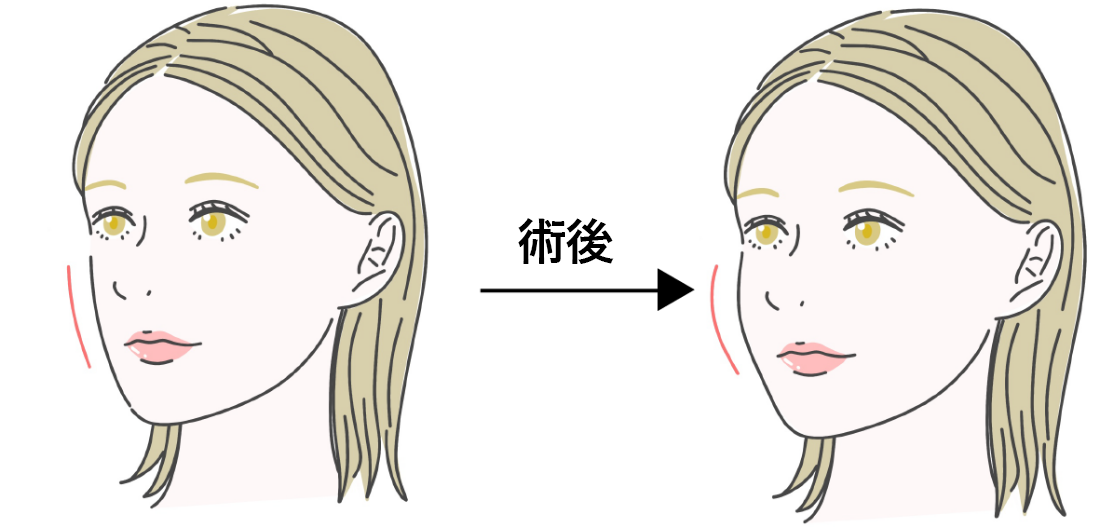 經結膜的眼窩脂肪移動術evo Lift Method