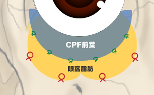 之後沿著眼窩緣縫合隔膜・CPF前葉複合瓣。這是預防復發的關鍵。(正面示意圖)