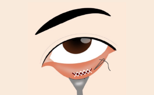 After carefully checking to avoid complications such as entropion、 the incision is closed and the procedure is complete.