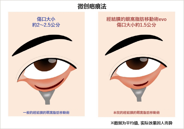採用Micro Scar Method微創技術傷口更小、不易留下痕跡