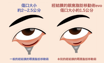 採用Micro Scar Method微創技術 傷口更小、不易留下痕跡