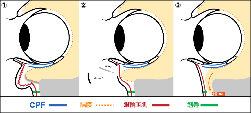 什麼是外開去眼袋・皮膚切除（經皮經結膜脂肪重新定位法evo）?