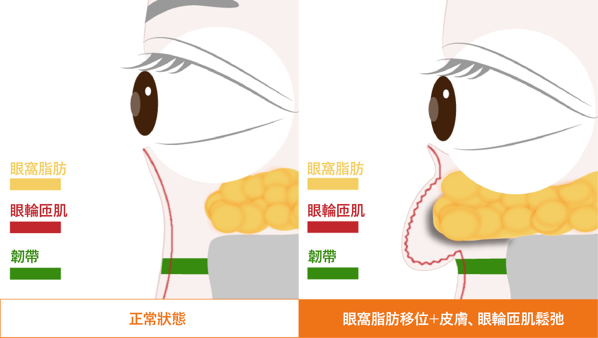 膨らみ溝の成り立ち