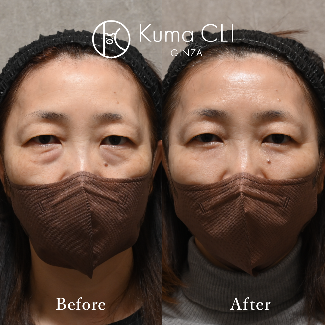 Subciliary Orbital Fat Repositioning evo