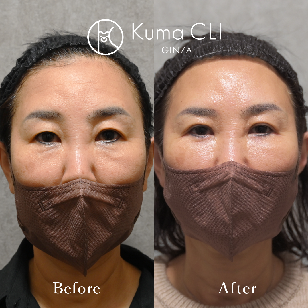 Subciliary Orbital Fat Repositioning evo
