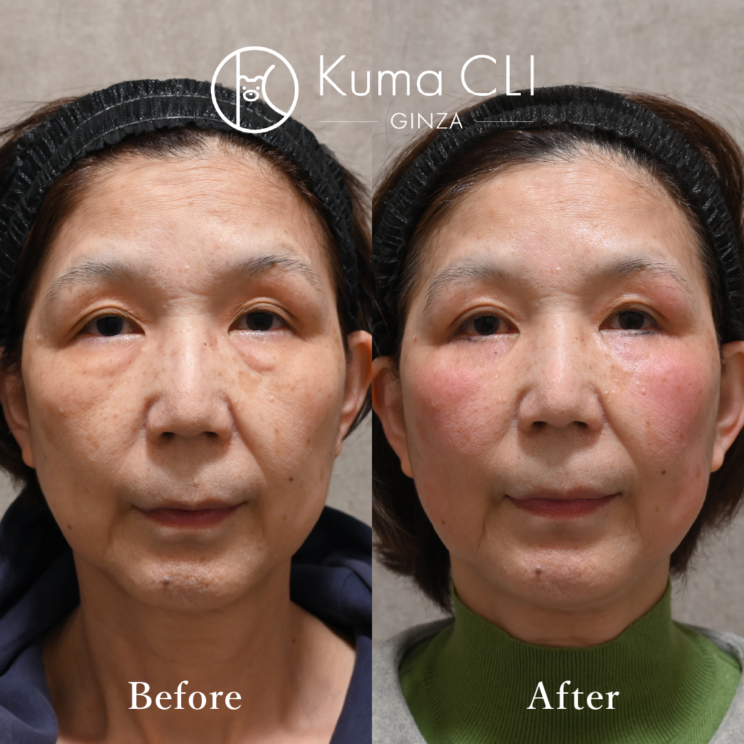 Subciliary Orbital Fat Repositioning evo