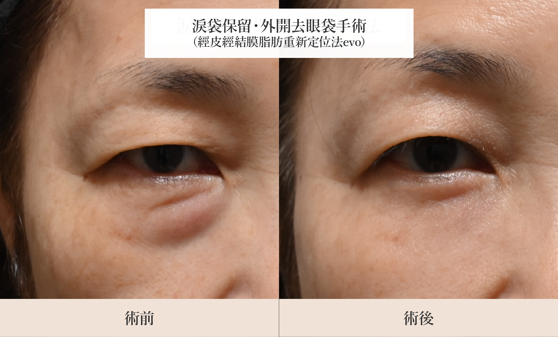 保留淚袋、自然有立體感的下眼部