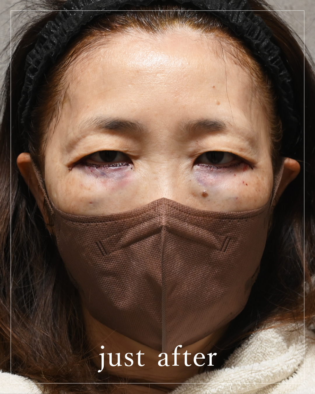 術後當下