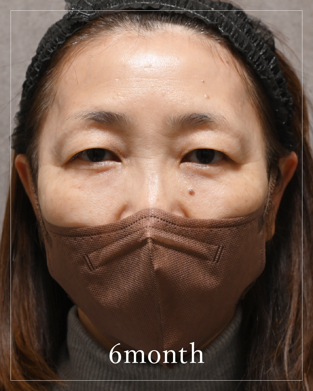 6 months after the procedure