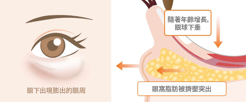 Causes of Dark Circles