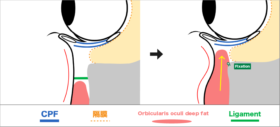 裏ハムラ法とは