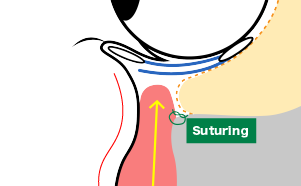 上顎骨と眼輪筋・眼輪筋下脂肪体を剥離し、さらに靭帯を剥離して、後々眼窩脂肪ズラすためのポケットを作成