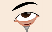 Local anesthesia is administered, and after confirming pain relief/sedation, a small incision (~1.5 cm) is made inside the lower eyelid.