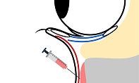 Harvest fat (e.g., from the thigh) and inject it to fill the hollow between the under-eye and the cheek, adding volume to the upper cheek.