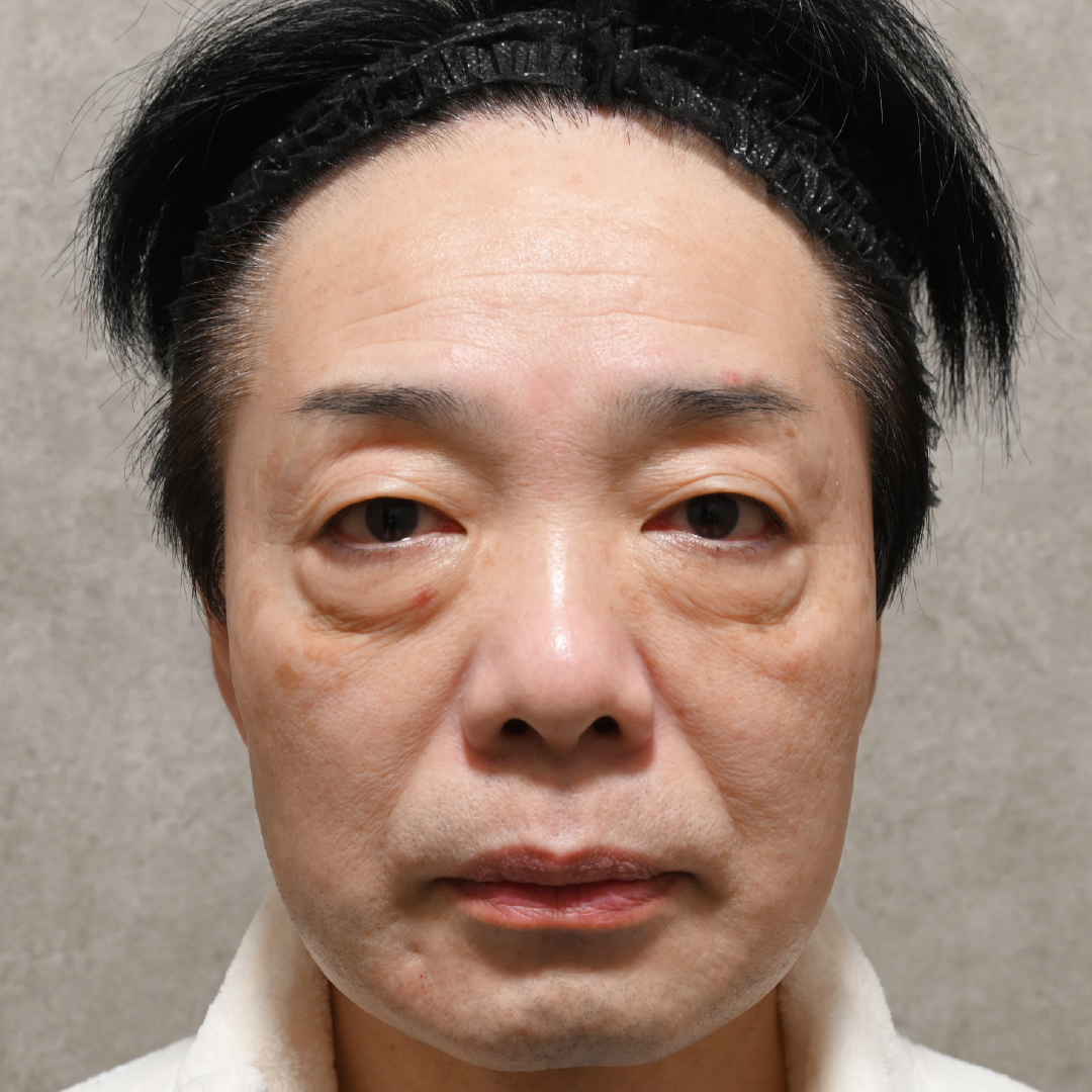 Candidates for the  Transcutaneous Midface Lift