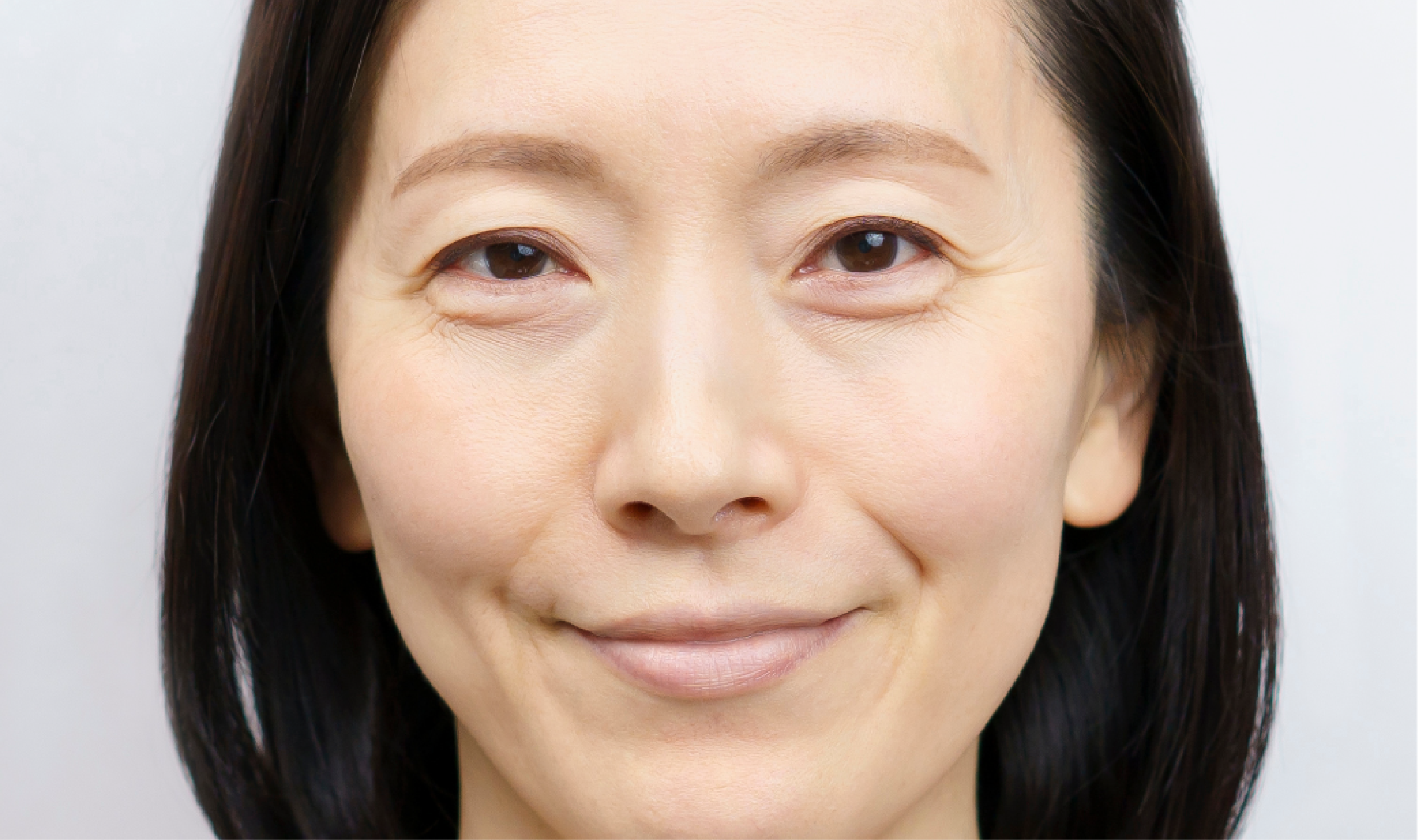Transcutaneous Midface Lift