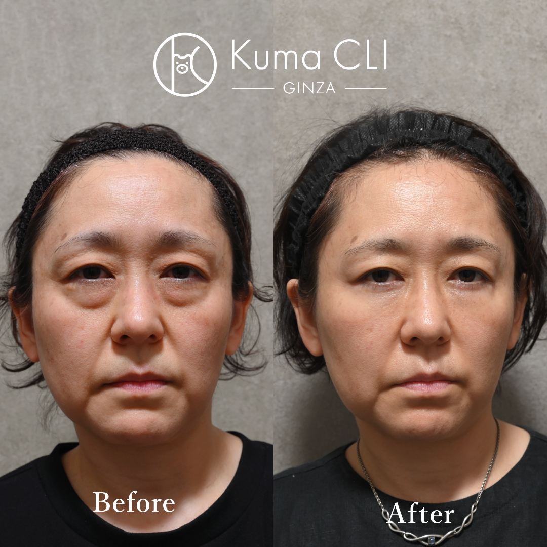 Transcutaneous Midface Lift