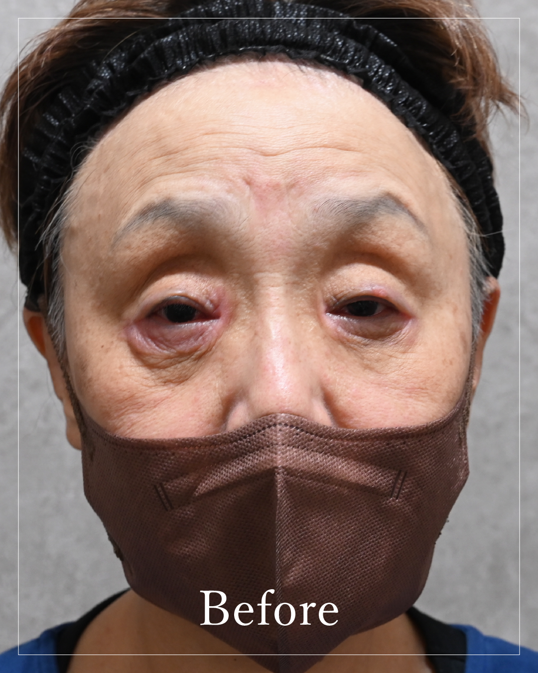 Before the procedure