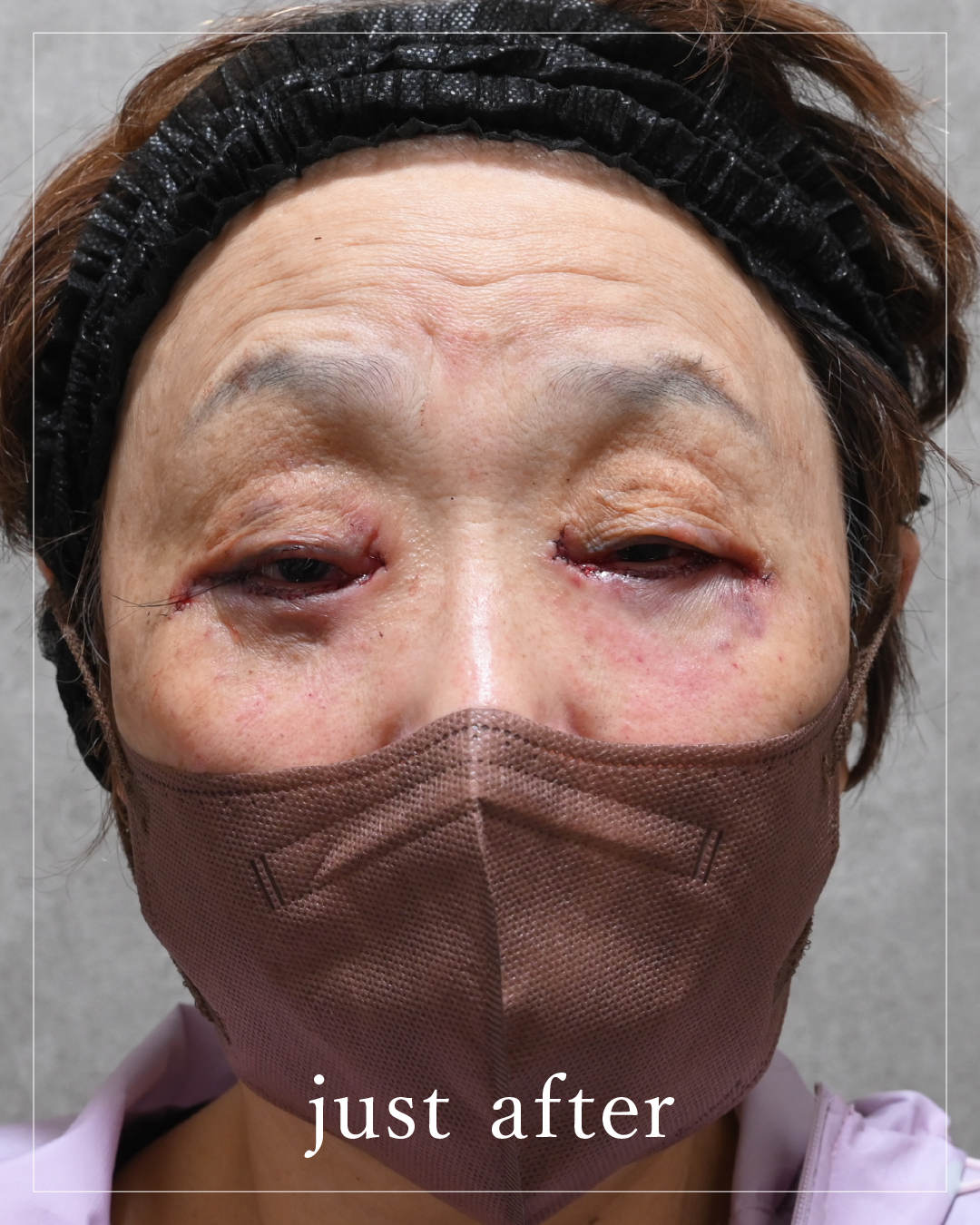Immediately after the procedure