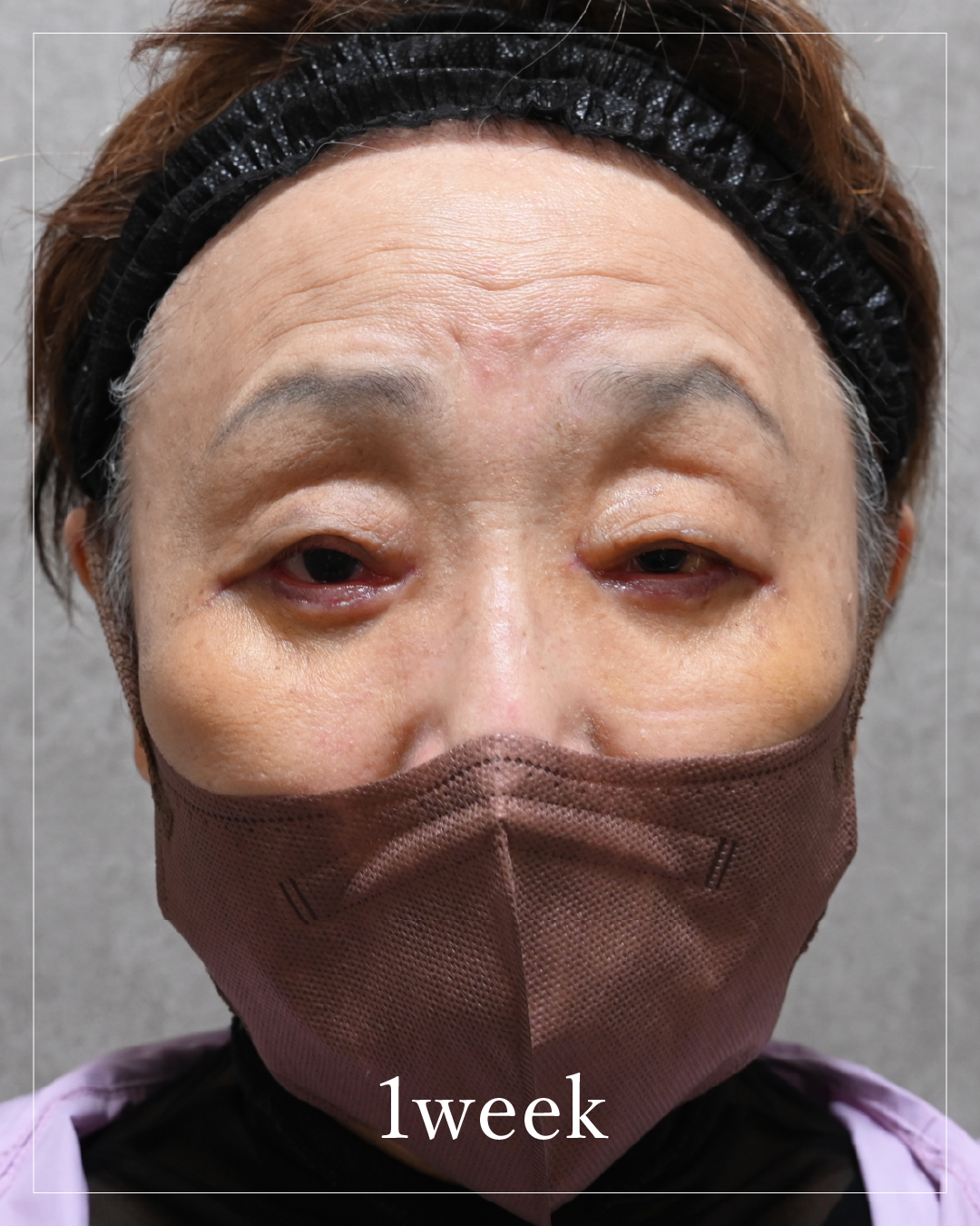 1 week after the procedure