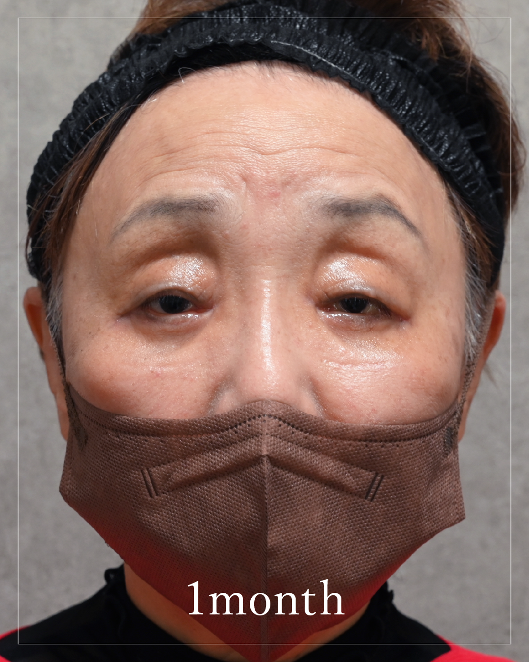 1 month after the procedure