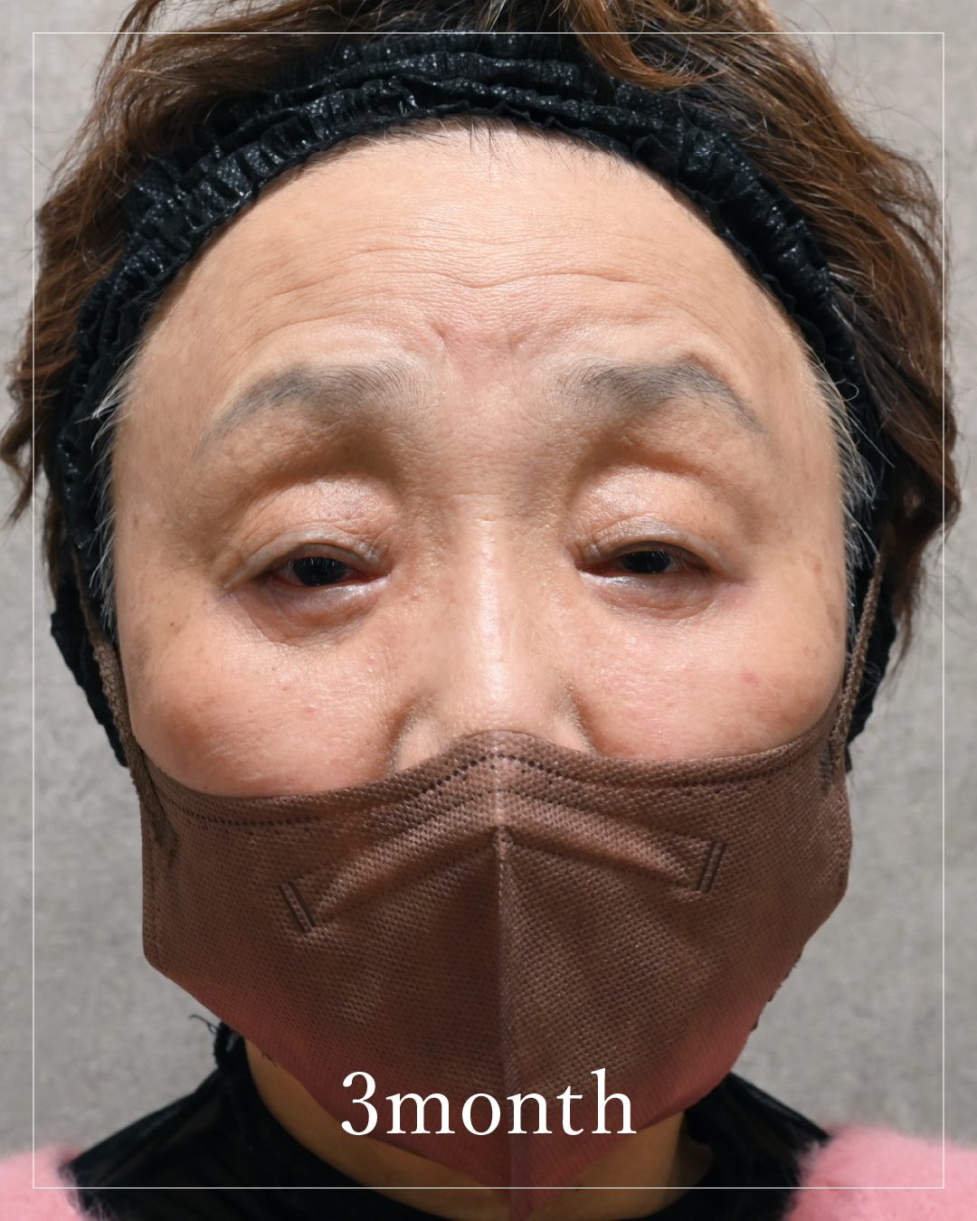 3 months after the procedure