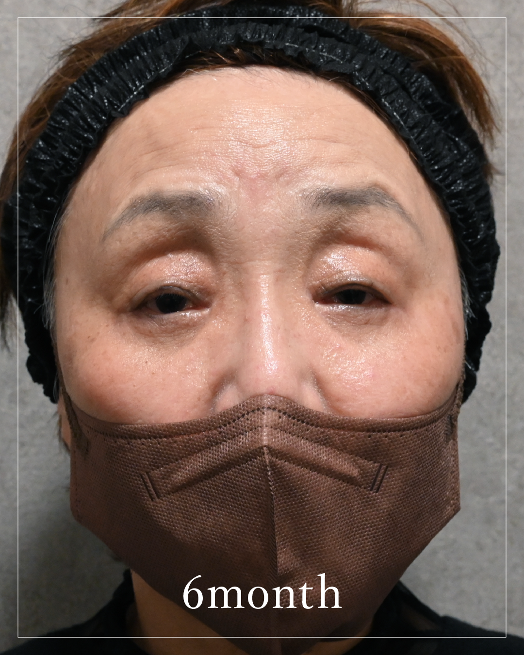 6 months after the procedure
