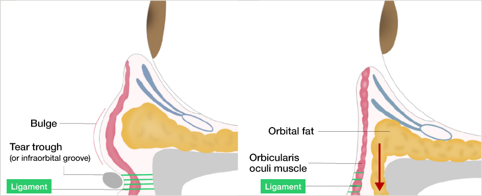 What is the Transconjunctival Orbital Fat Repositioning?