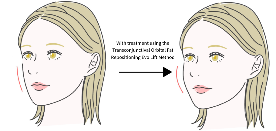 Transconjunctival Orbital Fat Repositioning Evo Lift Method