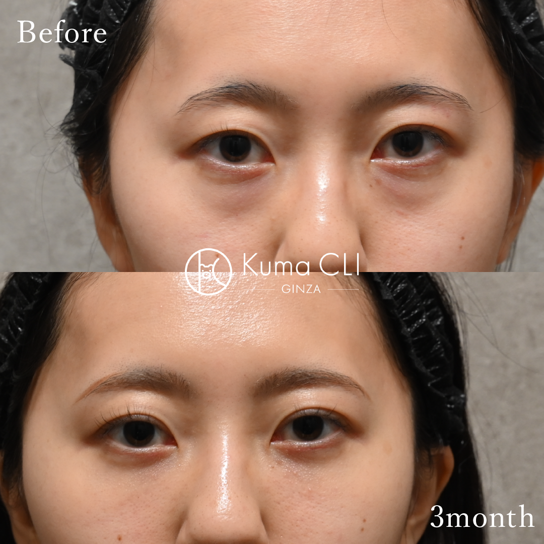 Transconjunctival Orbital Fat Repositioning Evo