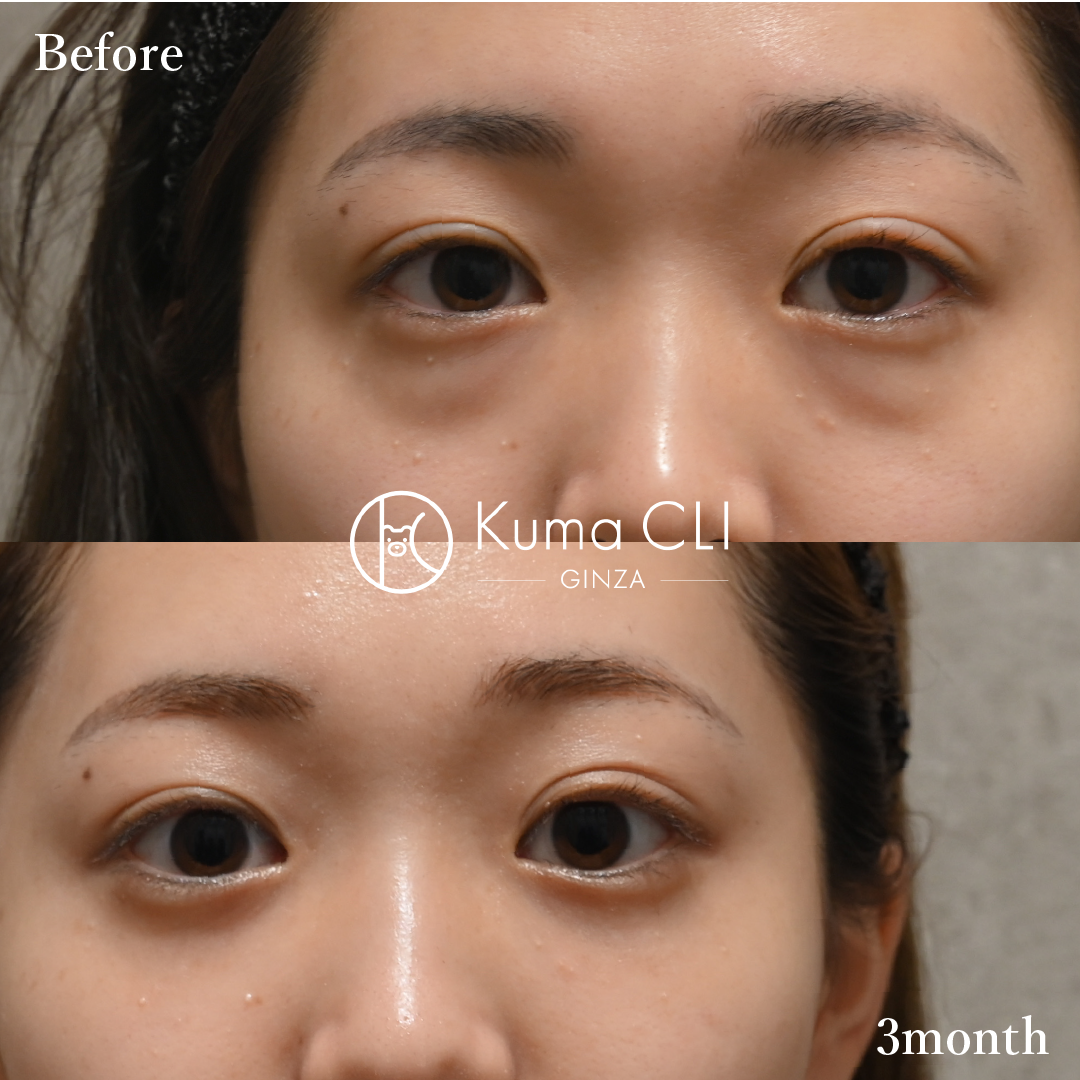 Transconjunctival Orbital Fat Repositioning Evo