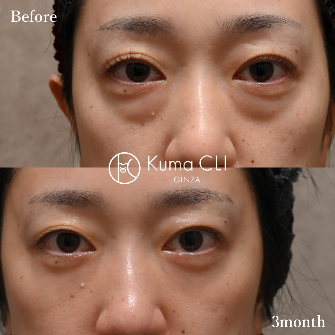Transconjunctival Orbital Fat Repositioning Evo