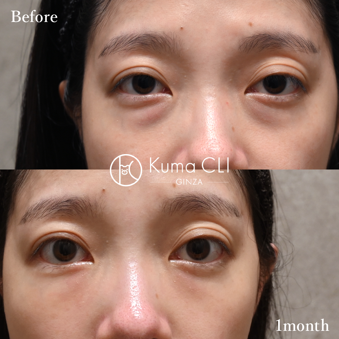 Transconjunctival Orbital Fat Repositioning Evo