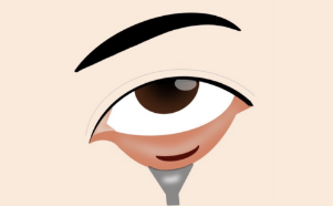After confirming pain relief and sedation, a small incision (about 1.5 cm) is made inside the lower eyelid to begin treatment.