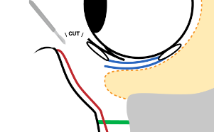 The space between the orbicularis oculi muscle and orbital fat is dissected.