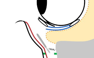The maxilla, orbicularis oculi muscle, and sub-orbicularis oculi fat are separated, along with the ligaments, to create a pocket for repositioning the orbital fat.