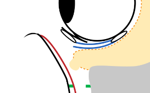 The septum is opened, and an orbital fat flap plus a septum–CPF anterior leaf composite flap is prepared.