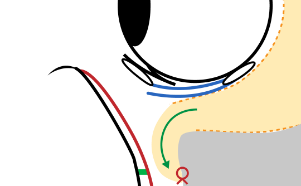 Orbital fat is shifted beneath the dissected ligament and fixed with absorbable sutures. Eventually, the tissue adheres in place as the sutures dissolve.