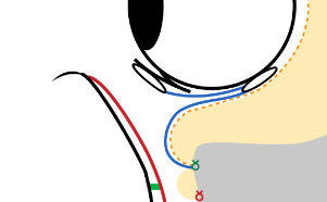 The septum–CPF anterior leaf composite flap is then sutured along the orbital rim. This is the key to preventing recurrence. (Side view illustration)
