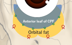 Next, the composite flap of the septum and anterior leaflet of the CPF is sutured along the orbital rim. This step is key for preventing recurrence. (Front view illustration)
